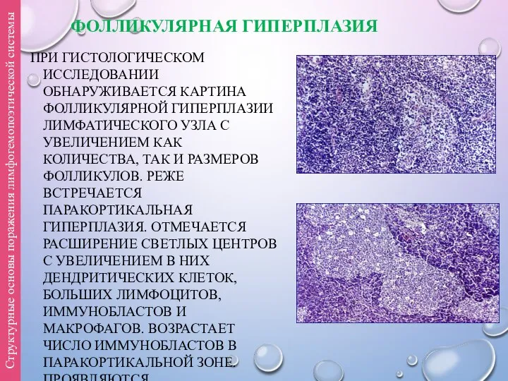 ФОЛЛИКУЛЯРНАЯ ГИПЕРПЛАЗИЯ ПРИ ГИСТОЛОГИЧЕСКОМ ИССЛЕДОВАНИИ ОБНАРУЖИВАЕТСЯ КАРТИНА ФОЛЛИКУЛЯРНОЙ ГИПЕРПЛАЗИИ ЛИМФАТИЧЕСКОГО УЗЛА