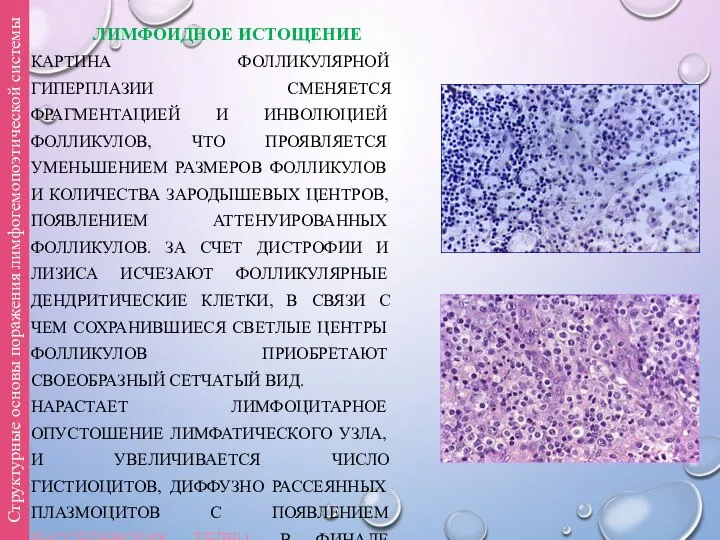ЛИМФОИДНОЕ ИСТОЩЕНИЕ КАРТИНА ФОЛЛИКУЛЯРНОЙ ГИПЕРПЛАЗИИ СМЕНЯЕТСЯ ФРАГМЕНТАЦИЕЙ И ИНВОЛЮЦИЕЙ ФОЛЛИКУЛОВ, ЧТО