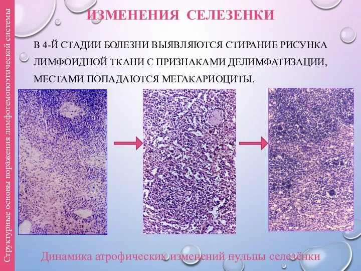 ИЗМЕНЕНИЯ СЕЛЕЗЕНКИ В 4-Й СТАДИИ БОЛЕЗНИ ВЫЯВЛЯЮТСЯ СТИРАНИЕ РИСУНКА ЛИМФОИДНОЙ ТКАНИ