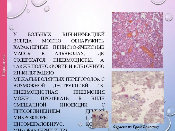 У БОЛЬНЫХ ВИЧ-ИНФЕКЦИЕЙ ВСЕГДА МОЖНО ОБНАРУЖИТЬ ХАРАКТЕРНЫЕ ПЕНИСТО-ЯЧЕИСТЫЕ МАССЫ В АЛЬВЕОЛАХ,