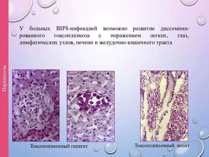Токсоплазменный гепатит Токсоплазменный колит Паразитозы У больных ВИЧ-инфекцией возможно развитие диссемини-рованного