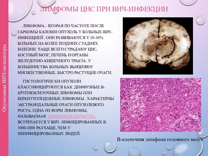 ЛИМФОМЫ ЦНС ПРИ ВИЧ-ИНФЕКЦИИ ЛИМФОМА - ВТОРАЯ ПО ЧАСТОТЕ ПОСЛЕ САРКОМЫ