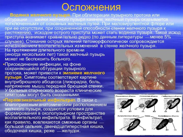 Осложнения Водянка желчного пузыря. При облитерации пузырного протока или обтурации шейки