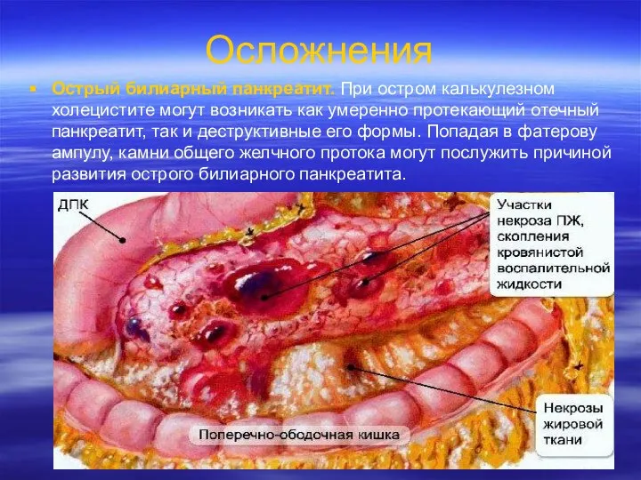 Осложнения Острый билиарный панкреатит. При остром калькулезном холецистите могут возникать как