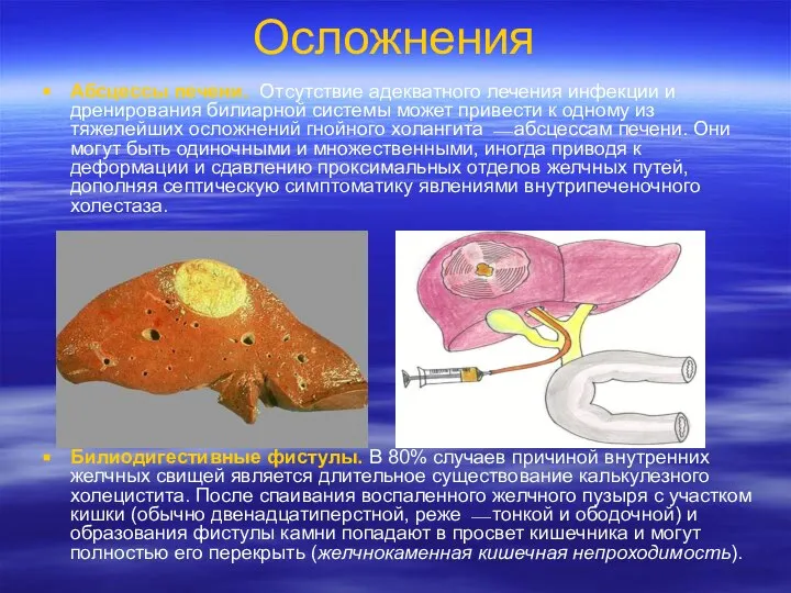 Осложнения Абсцессы печени. Отсутствие адекватного лечения инфекции и дренирования билиарной системы