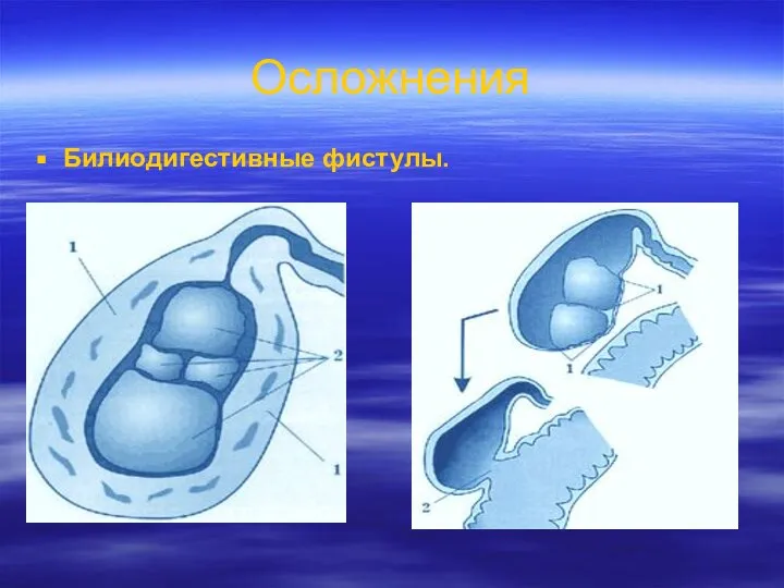 Осложнения Билиодигестивные фистулы.