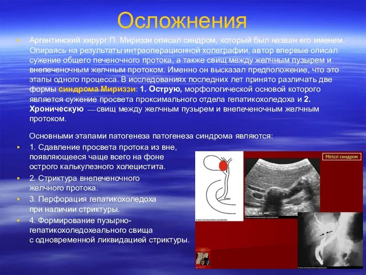 Осложнения Аргентинский хирург П. Мириззи описал синдром, который был назван его