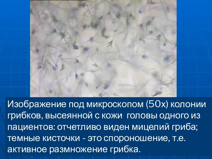 Изображение под микроскопом (50х) колонии грибков, высеянной с кожи головы одного