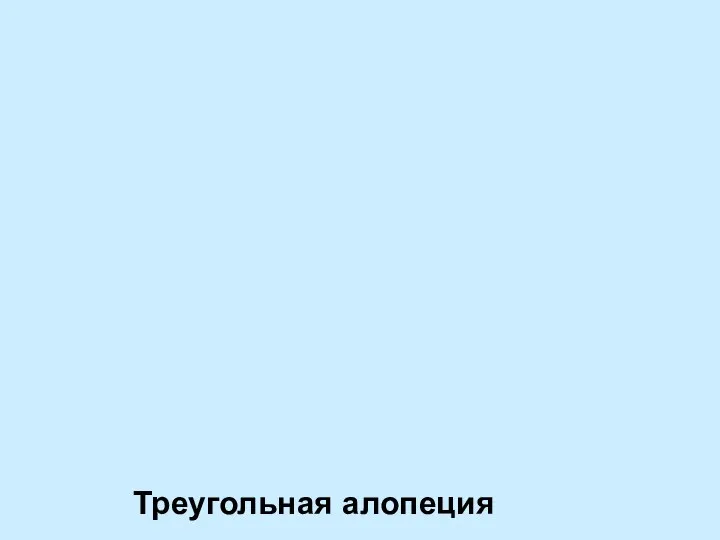 Треугольная алопеция