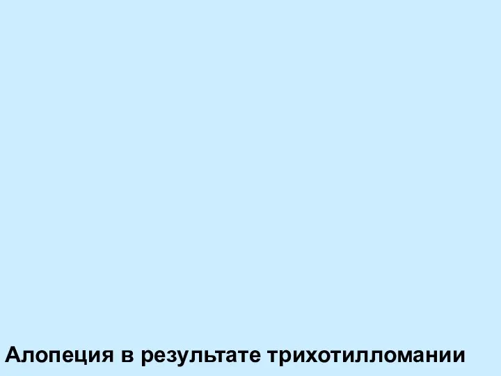 Алопеция в результате трихотилломании