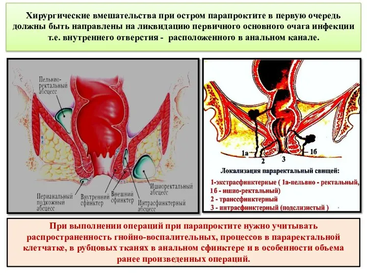 Хирургические вмешательства при остром парапроктите в первую очередь должны быть направлены