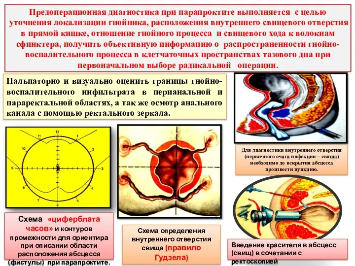 Предоперационная диагностика при парапроктите выполняется с целью уточнения локализации гнойника, расположения