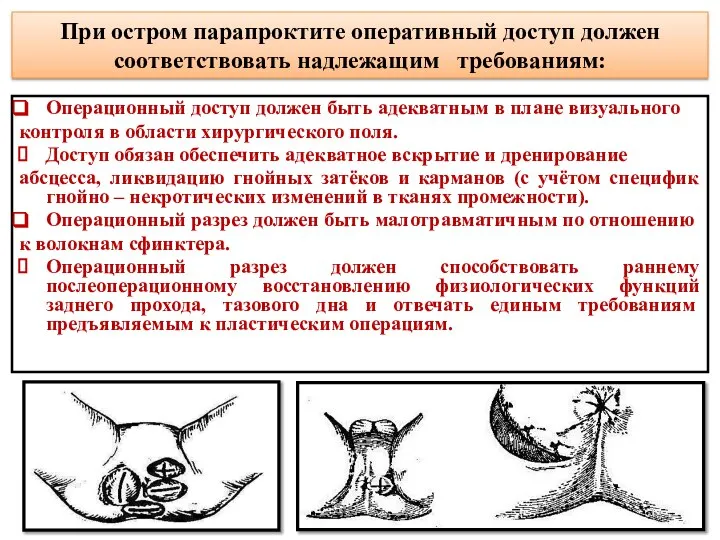 При остром парапроктите оперативный доступ должен соответствовать надлежащим требованиям: Операционный доступ