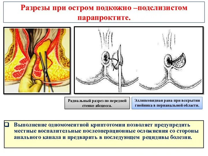 Разрезы при остром подкожно –подслизистом парапроктите. Выполнение одномоментной криптотомии позволяет предупредить