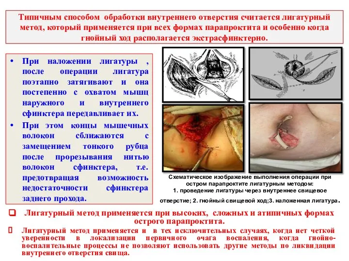 Типичным способом обработки внутреннего отверстия считается лигатурный метод, который применяется при