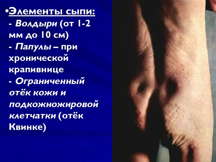 Элементы сыпи: - Волдыри (от 1-2 мм до 10 см) -