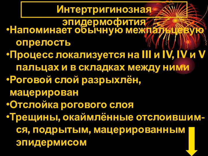 Интертригинозная эпидермофития Напоминает обычную межпальцевую опрелость Процесс локализуется на III и