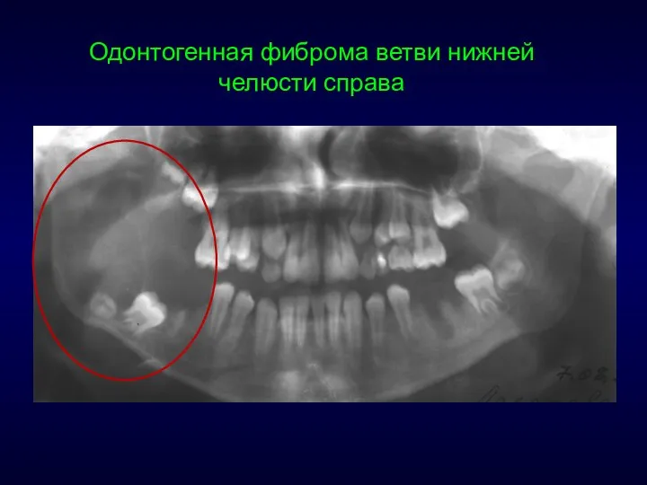 Одонтогенная фиброма ветви нижней челюсти справа