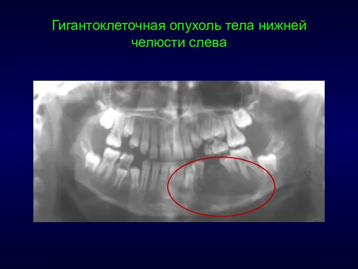 Гигантоклеточная опухоль тела нижней челюсти слева