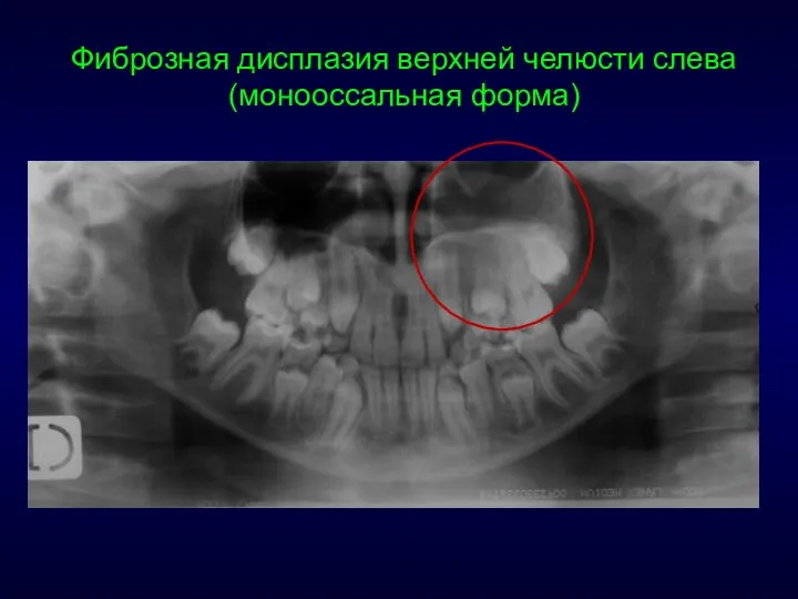 Фиброзная дисплазия верхней челюсти слева (монооссальная форма)