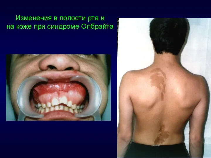 Изменения в полости рта и на коже при синдроме Олбрайта