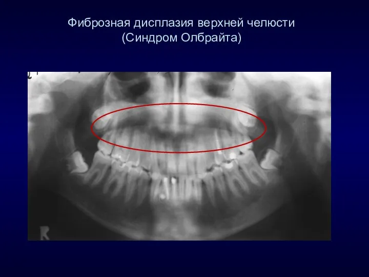 Фиброзная дисплазия верхней челюсти (Синдром Олбрайта)