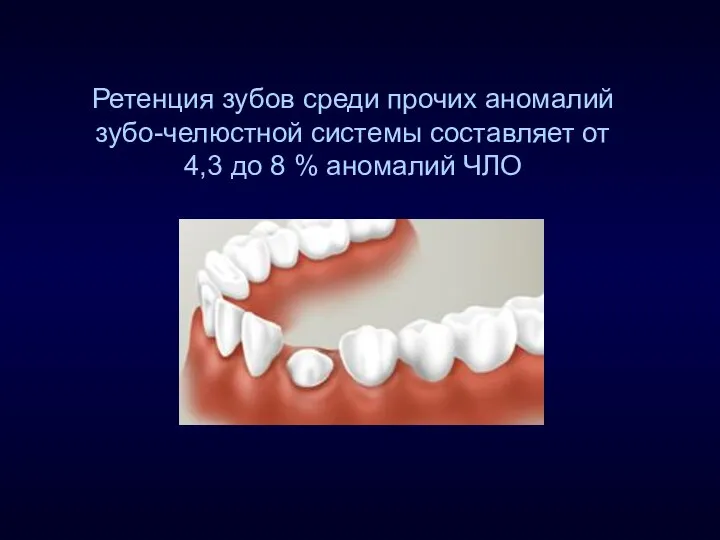Ретенция зубов среди прочих аномалий зубо-челюстной системы составляет от 4,3 до 8 % аномалий ЧЛО