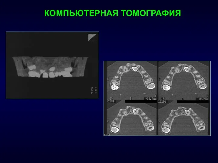 КОМПЬЮТЕРНАЯ ТОМОГРАФИЯ