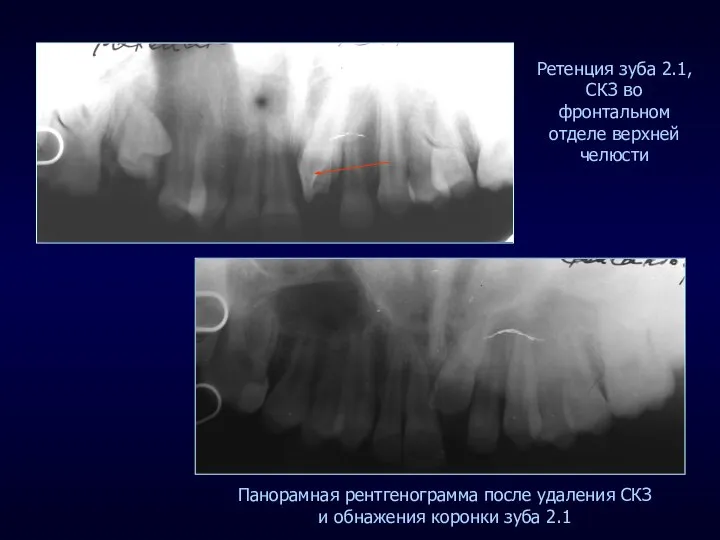 Ретенция зуба 2.1, СКЗ во фронтальном отделе верхней челюсти Панорамная рентгенограмма