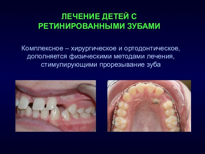 ЛЕЧЕНИЕ ДЕТЕЙ С РЕТИНИРОВАННЫМИ ЗУБАМИ Комплексное – хирургическое и ортодонтическое, дополняется