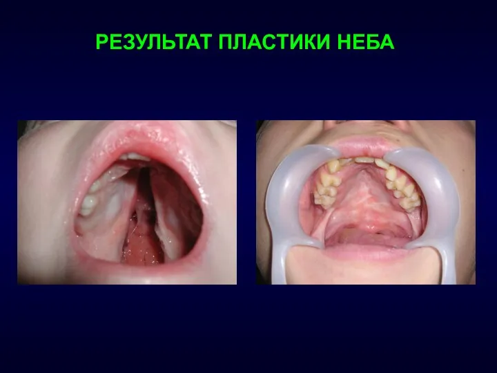 РЕЗУЛЬТАТ ПЛАСТИКИ НЕБА