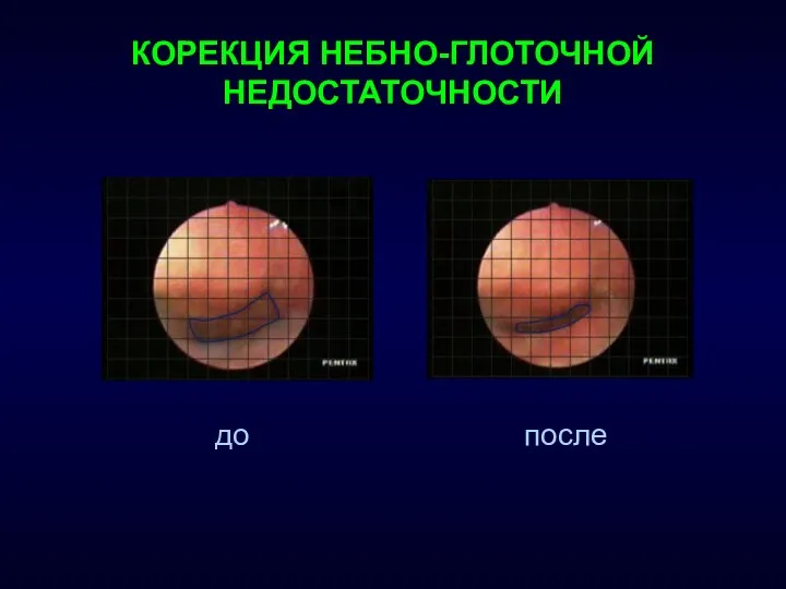 КОРЕКЦИЯ НЕБНО-ГЛОТОЧНОЙ НЕДОСТАТОЧНОСТИ