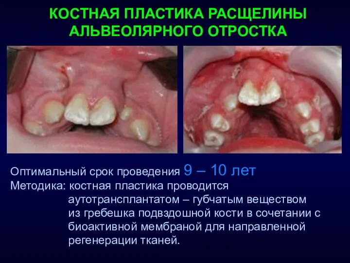 КОСТНАЯ ПЛАСТИКА РАСЩЕЛИНЫ АЛЬВЕОЛЯРНОГО ОТРОСТКА Оптимальный срок проведения 9 – 10