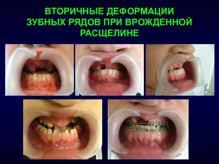 ВТОРИЧНЫЕ ДЕФОРМАЦИИ ЗУБНЫХ РЯДОВ ПРИ ВРОЖДЕННОЙ РАСЩЕЛИНЕ