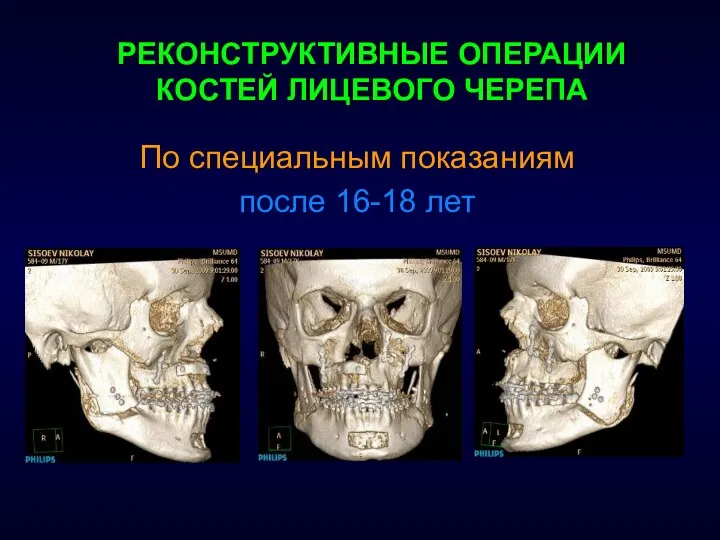 РЕКОНСТРУКТИВНЫЕ ОПЕРАЦИИ КОСТЕЙ ЛИЦЕВОГО ЧЕРЕПА По специальным показаниям после 16-18 лет