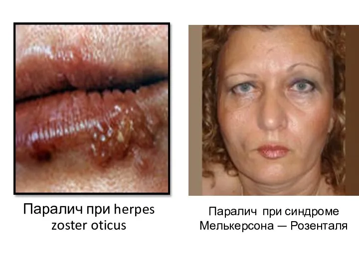 Паралич при herpes zoster oticus Паралич при синдроме Мелькерсона — Розенталя