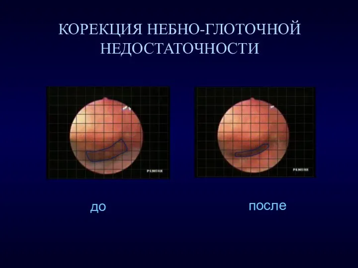 КОРЕКЦИЯ НЕБНО-ГЛОТОЧНОЙ НЕДОСТАТОЧНОСТИ