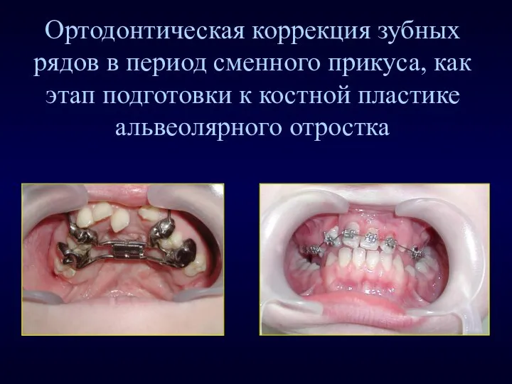 Ортодонтическая коррекция зубных рядов в период сменного прикуса, как этап подготовки к костной пластике альвеолярного отростка