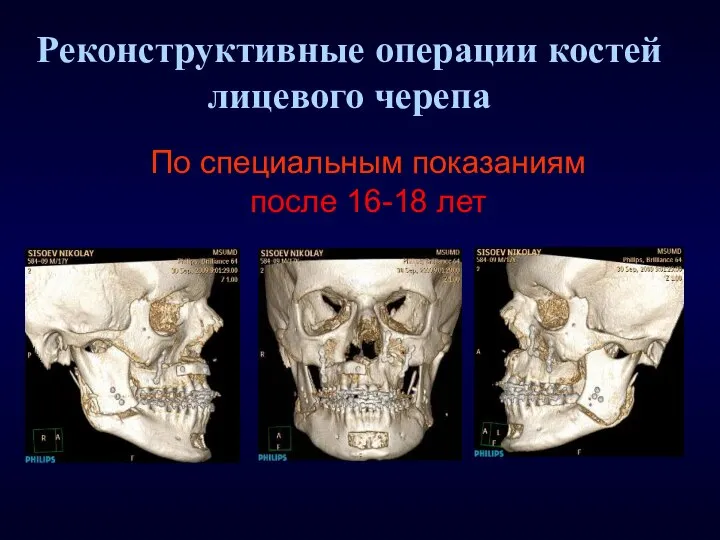 Реконструктивные операции костей лицевого черепа По специальным показаниям после 16-18 лет