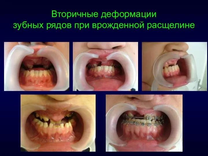 Вторичные деформации зубных рядов при врожденной расщелине