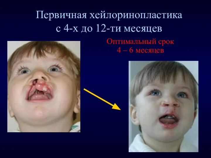 Первичная хейлоринопластика с 4-х до 12-ти месяцев Оптимальный срок 4 – 6 месяцев