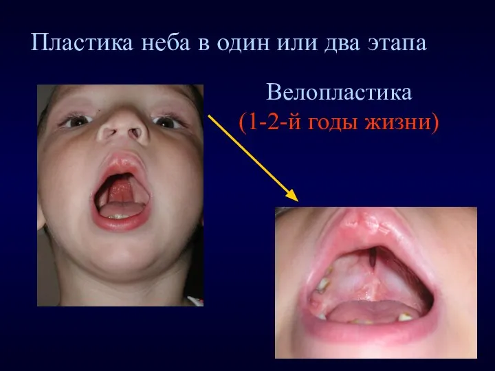 Велопластика (1-2-й годы жизни) Пластика неба в один или два этапа