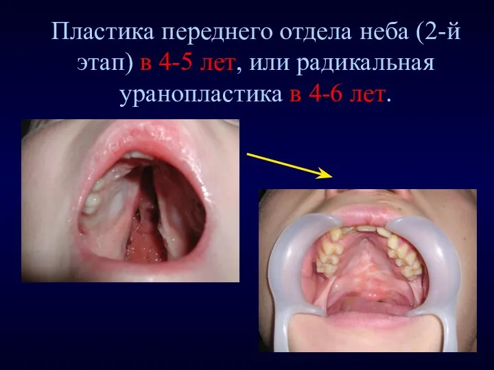 Пластика переднего отдела неба (2-й этап) в 4-5 лет, или радикальная уранопластика в 4-6 лет.