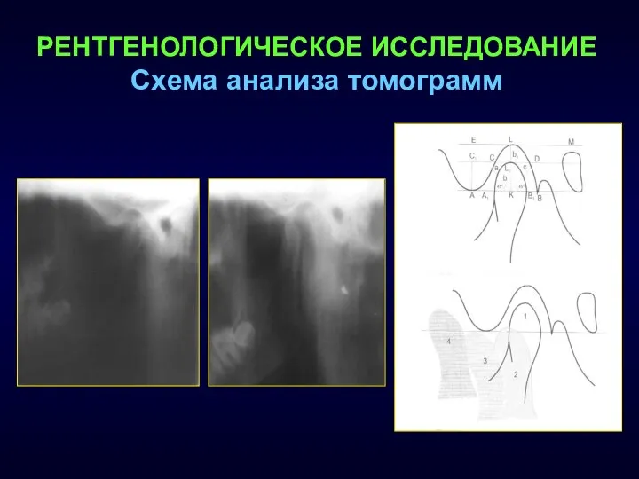 РЕНТГЕНОЛОГИЧЕСКОЕ ИССЛЕДОВАНИЕ Схема анализа томограмм