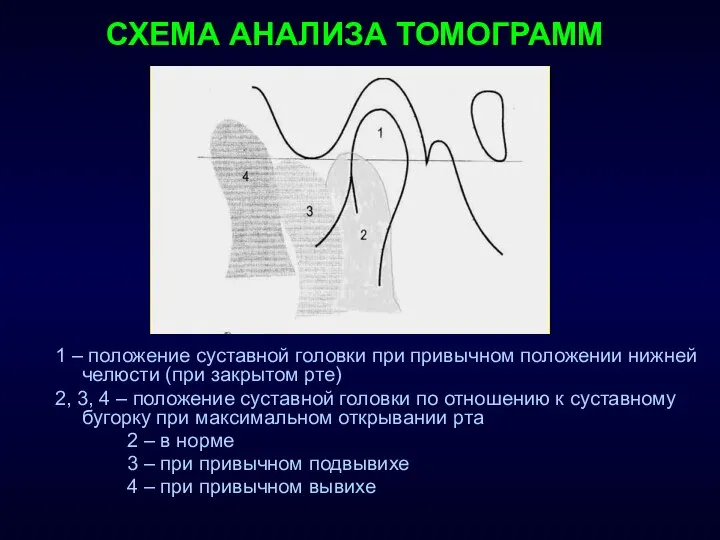 СХЕМА АНАЛИЗА ТОМОГРАММ 1 – положение суставной головки при привычном положении