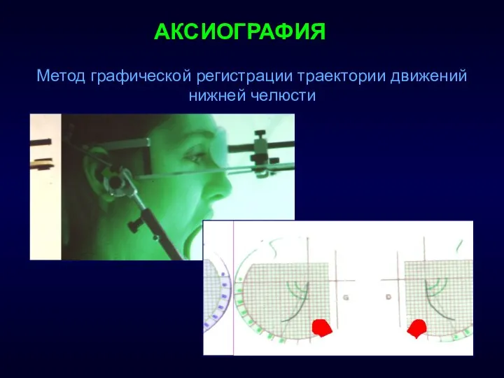 АКСИОГРАФИЯ Метод графической регистрации траектории движений нижней челюсти