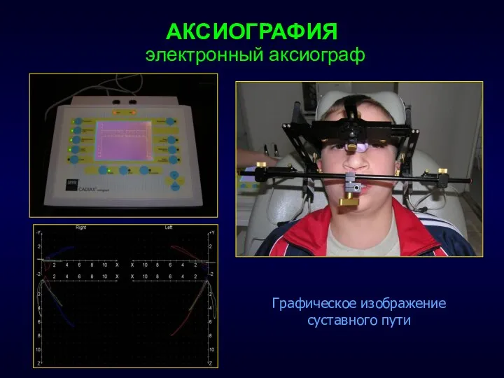 электронный аксиограф Графическое изображение суставного пути АКСИОГРАФИЯ