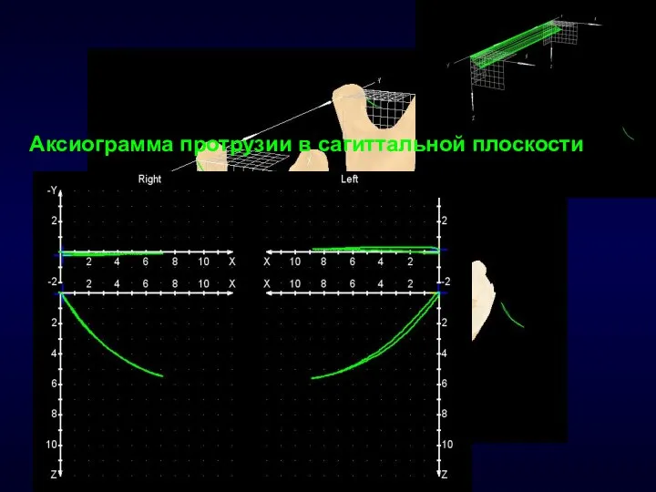 Аксиограмма протрузии в сагиттальной плоскости