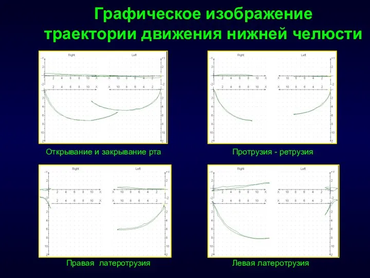 Графическое изображение траектории движения нижней челюсти Открывание и закрывание рта Протрузия