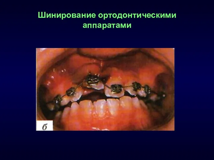 Шинирование ортодонтическими аппаратами